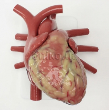 Larger Adult Heart (Non-Patent Vessels)