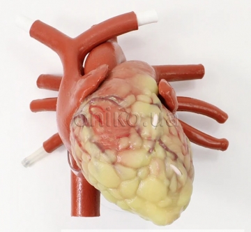 Larger Adult Minimally Invasive Cardiac Surgery Mitral and Coronary Artery Bypass Graft Heart