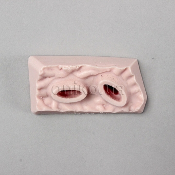 Inferior Gastric Ulcer Tissue