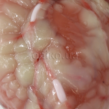 Coronary Artery Bypass Graft Sites